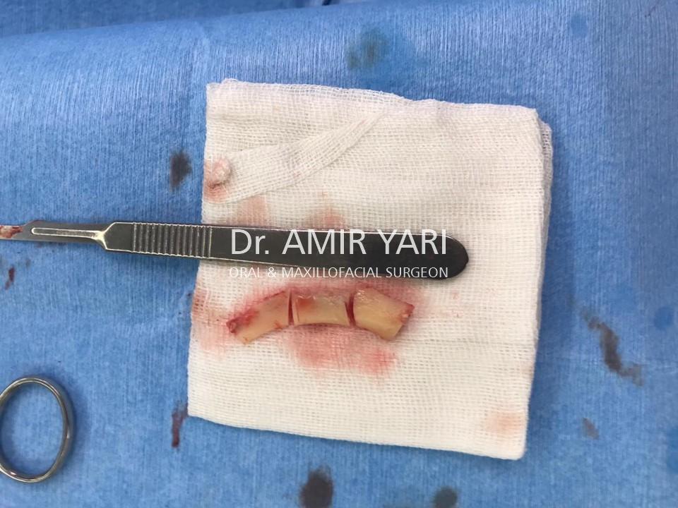 Amir Yari, Oral and Maxillofacial Surgery; bone harvesting