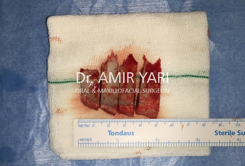 Amir Yari, Oral and Maxillofacial Surgery; bone harvesting from iliac