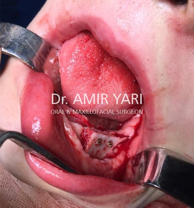 Amir Yari, Oral and Maxillofacial Surgery; mandibular augmentation